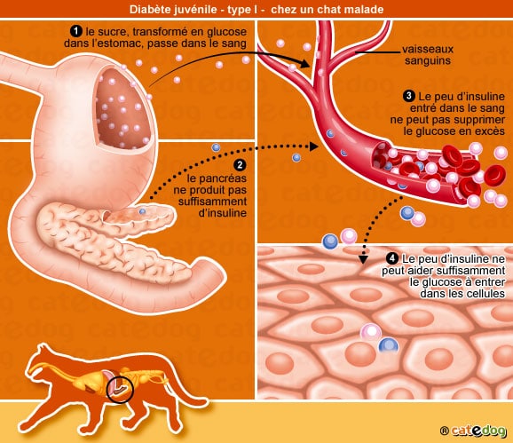 diabete-sucre-juvenile-type-I-chat