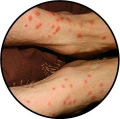 Piqures d'aoûtats sur la peau d'un homme