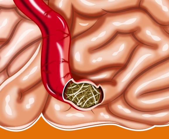 Boule de poil chez le chat avec occlusion intestinale